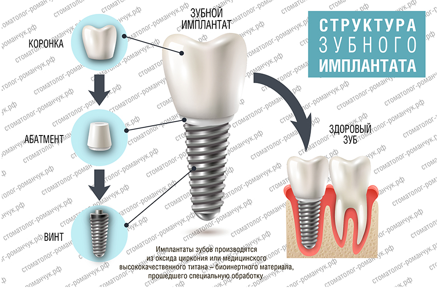 Структура и установка импланта зуба
