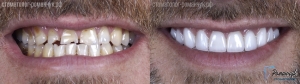 Тотальное протезирование зубов