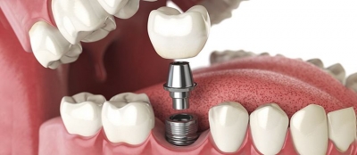 Имплантация зубов: 7 раз отмерь!